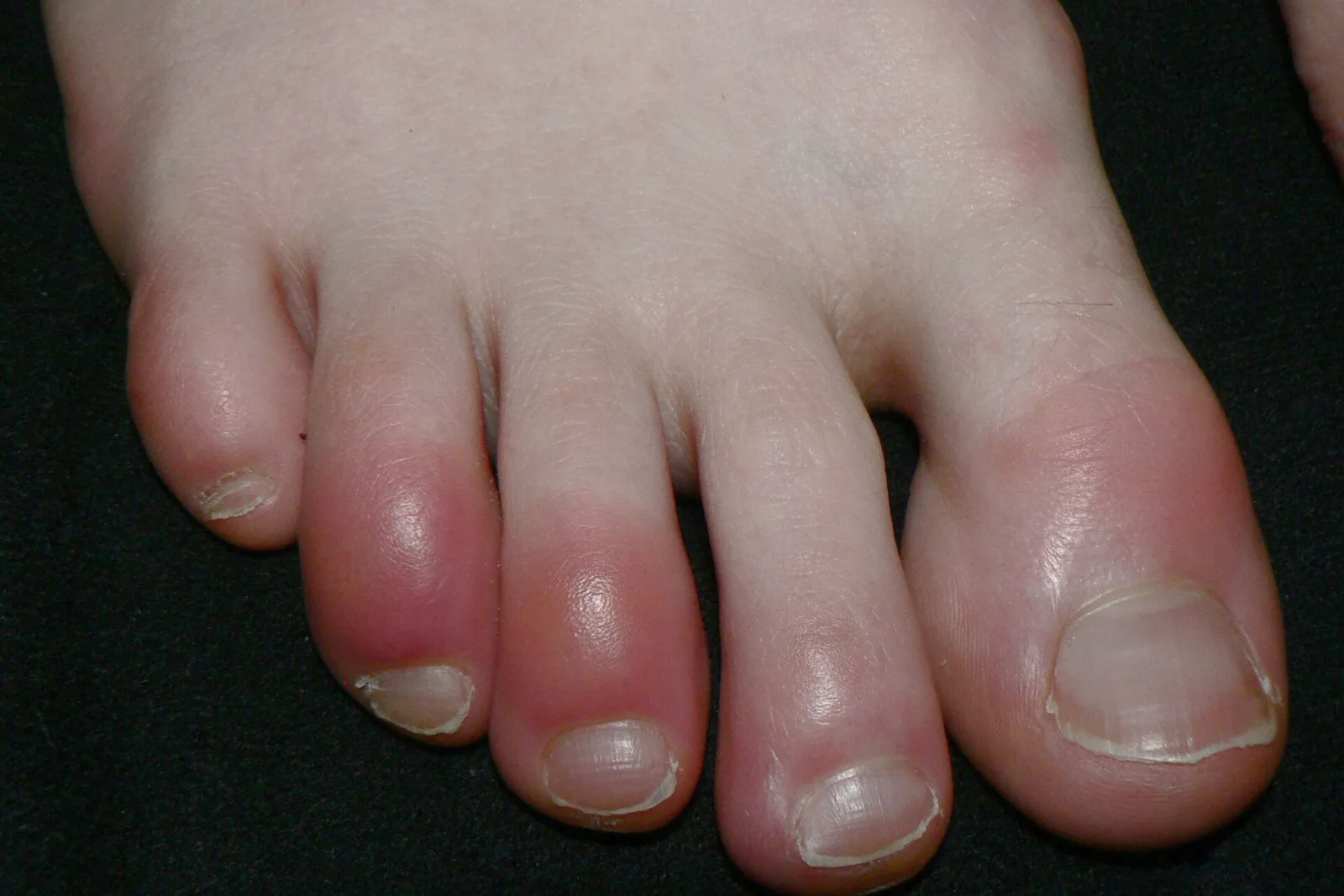 Toes with red, swollen patches typical of chilblains