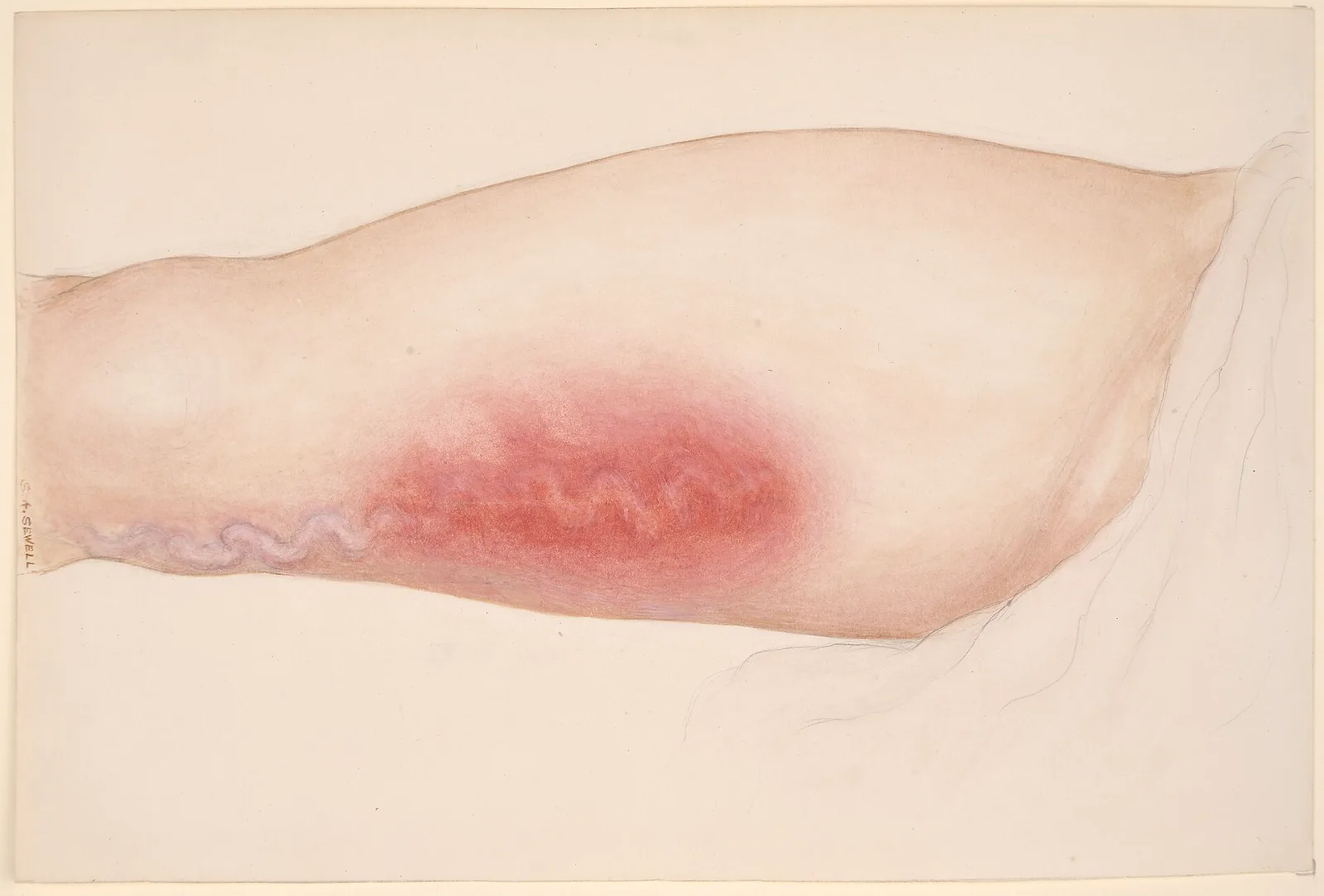 Historical medical watercolor of a leg with a large varicose vein, part of it red and inflamed