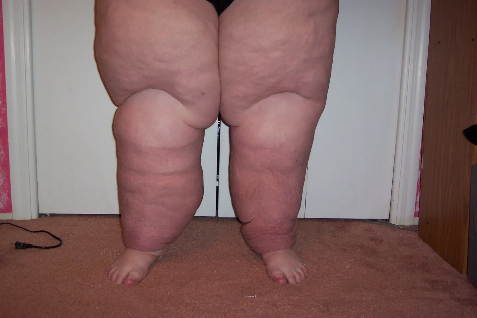 Both legs with advanced lymphedema, showing large, firm swelling and skin folds