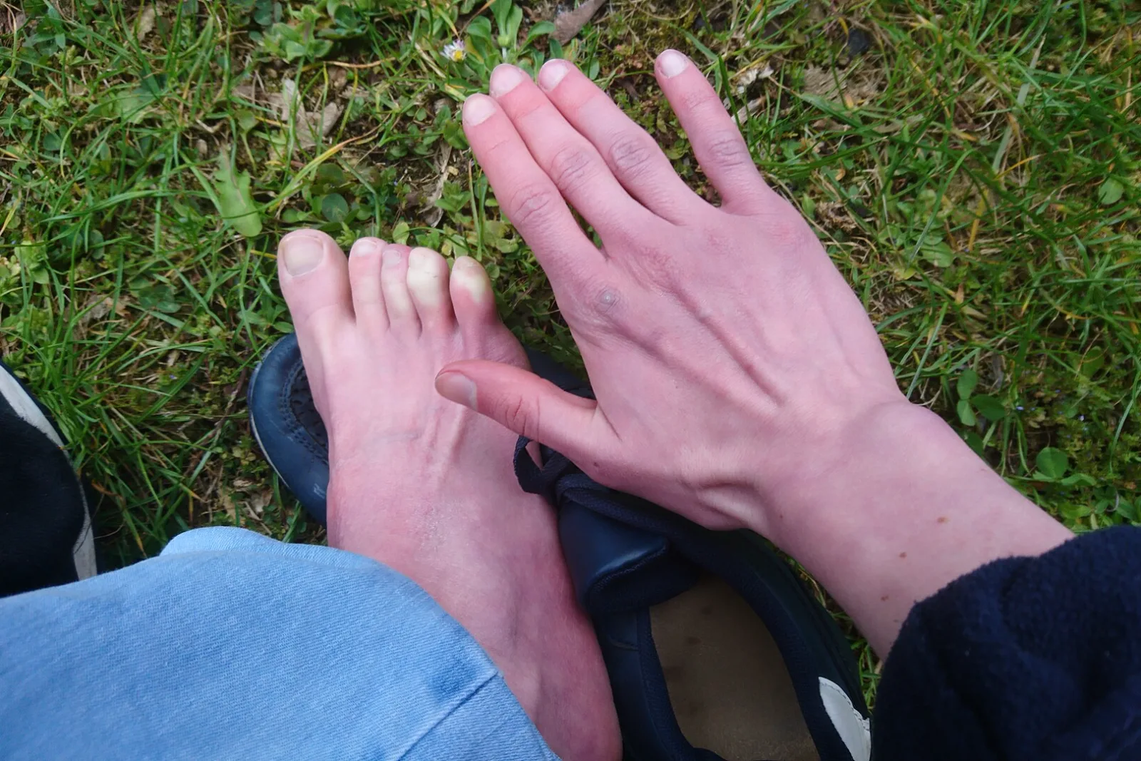 A hand and a foot side by side during a Raynaud's attack, with pale, discolored fingers and toes