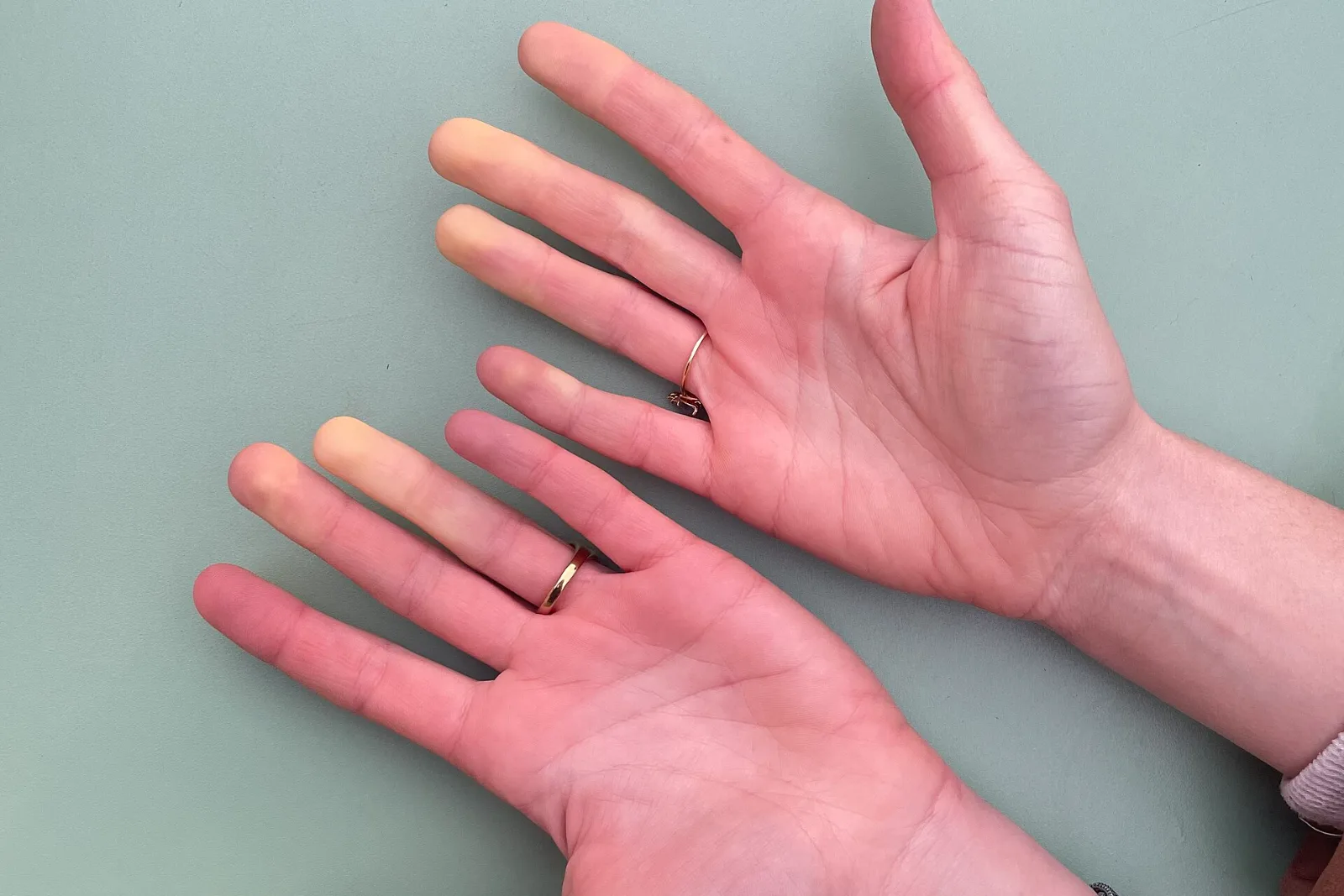 Two hands during a Raynaud's attack, several fingers pale white while the rest of the skin keeps its color