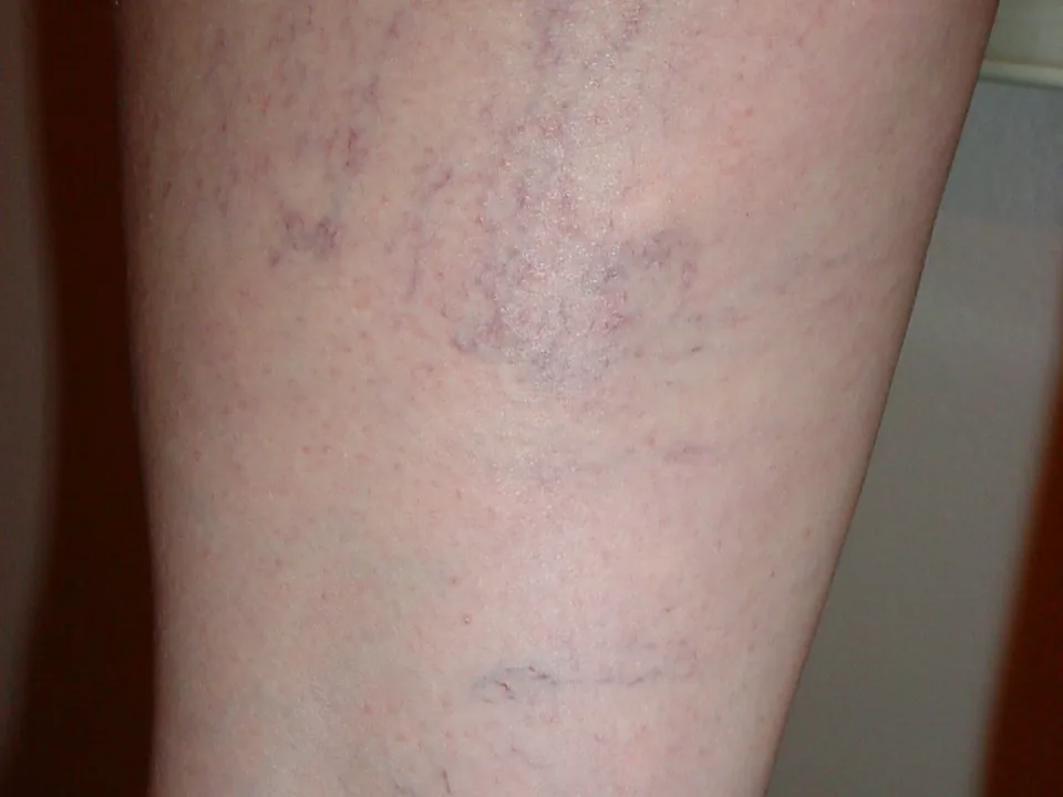 Fine red and purple spider veins on the skin of a leg