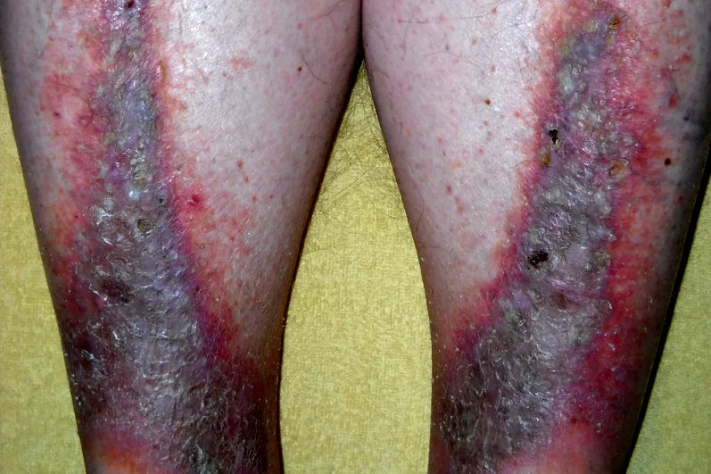 Both lower legs with brown-red discoloration, scaling and patches typical of stasis dermatitis