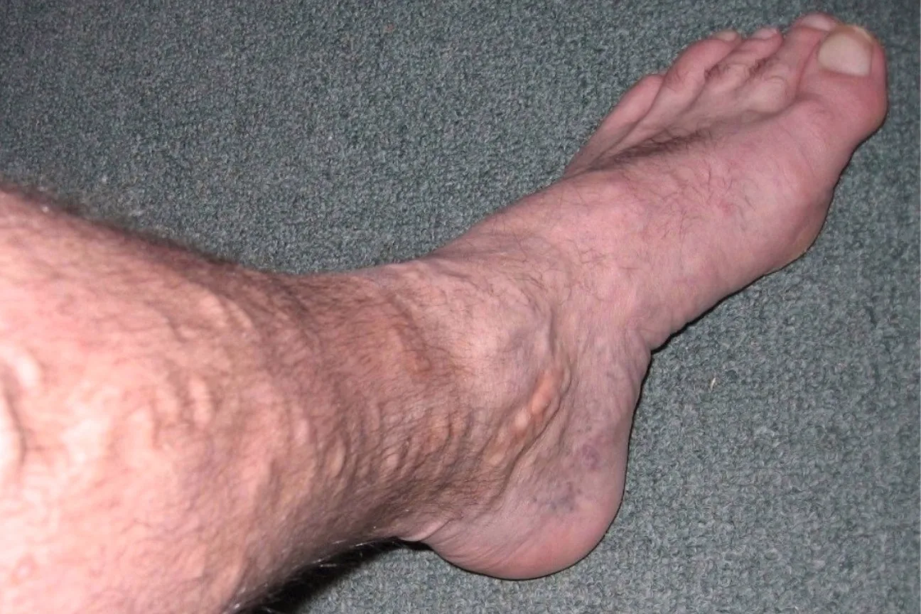 Bulging, twisted varicose veins on the lower leg and ankle