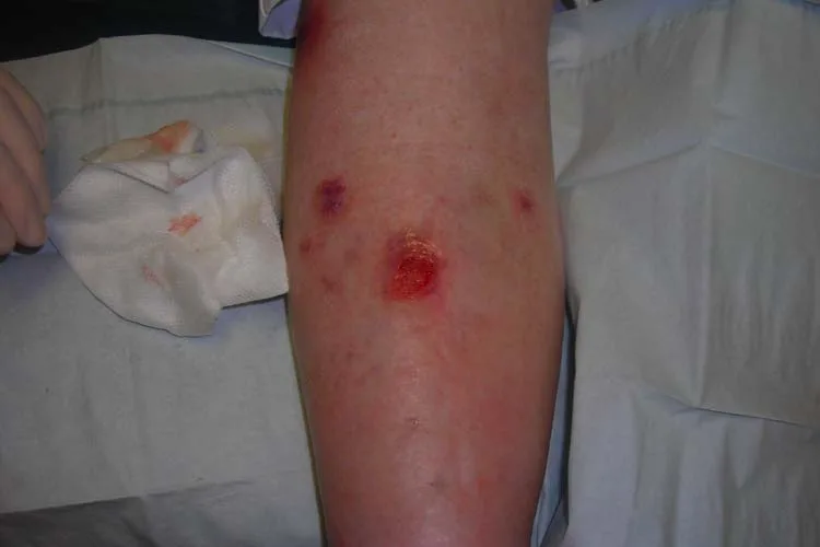 A shallow venous leg ulcer on the lower leg with discolored skin around it